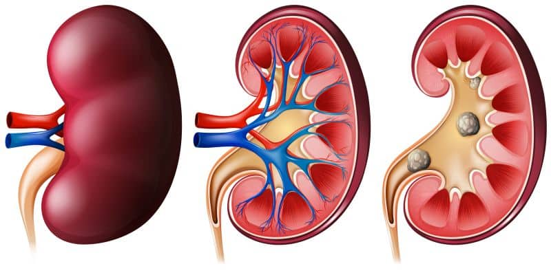 O avanço da tecnologia no tratamento dos cálculos renais: da litotripsia à cirurgia combinada com laser