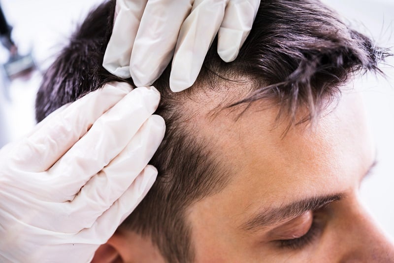 queda-de-cabelo-masculina